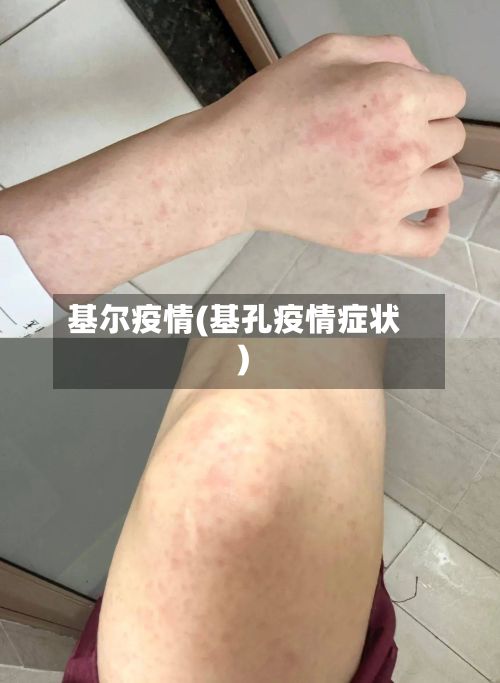 基尔疫情(基孔疫情症状)-第2张图片