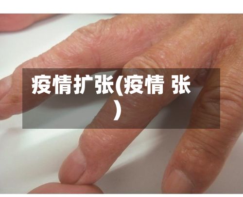 疫情扩张(疫情 张)