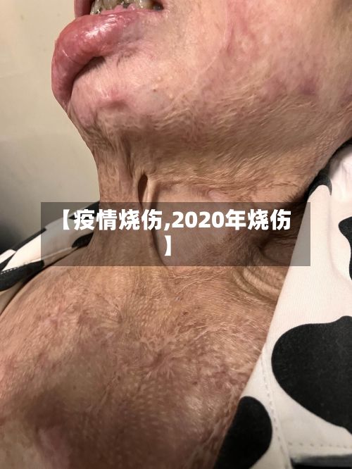 【疫情烧伤,2020年烧伤】-第3张图片